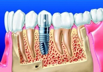 种植牙