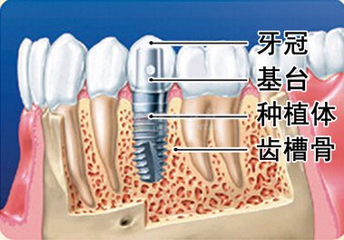 种牙价格