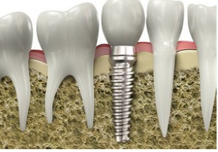 种植牙优点