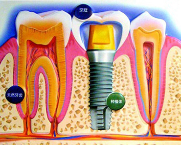 种植牙