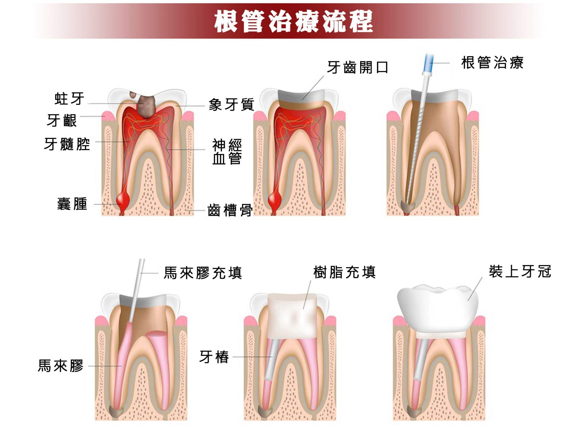 怎样才能避免根管治疗后牙疼呢？