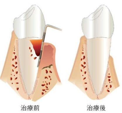 口腔不卫生易致牙周病