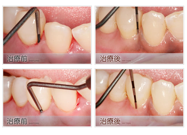 开始阶段并不严重,但如果不及时治疗会形成牙周袋和牙槽骨吸收症状